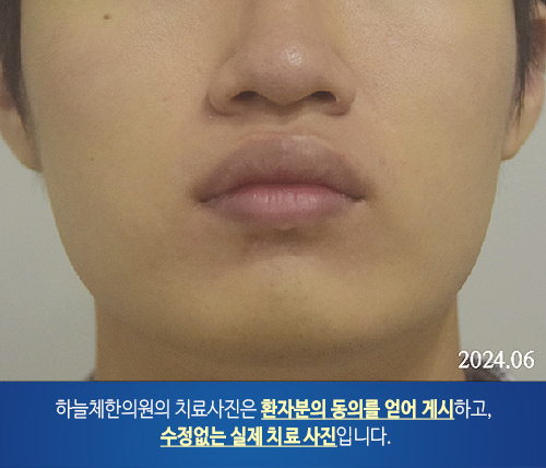  모낭염을 동반한 지루피부염 홍조