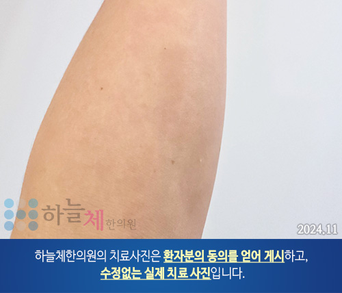 두드러기 치료