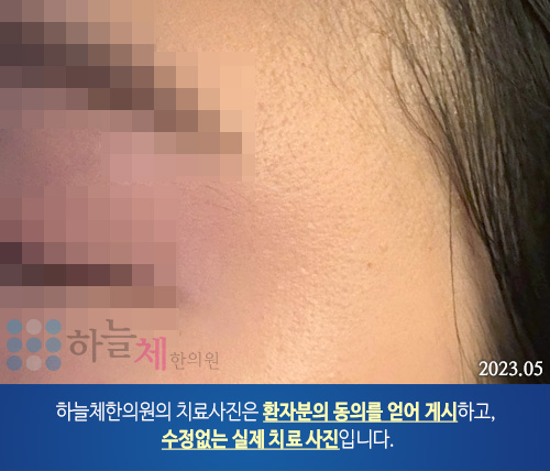편평 사마귀 치료