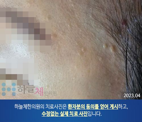 편평 사마귀 치료