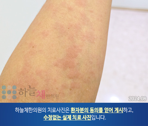 두드러기 치료