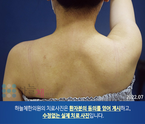 모낭염 치료