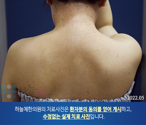 모낭염 치료