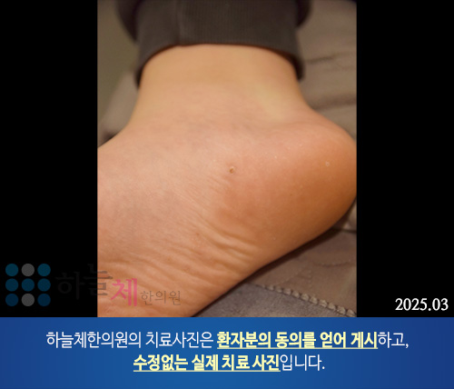발 사마귀 치료