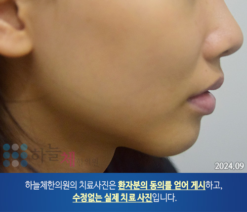 습진양 판상 병변 피부질환