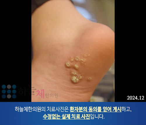 발 사마귀 치료