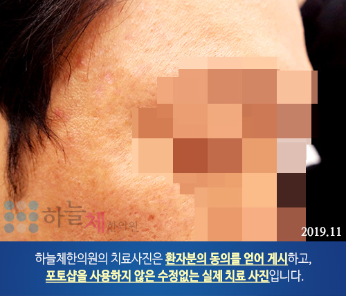 편평사마귀 치료