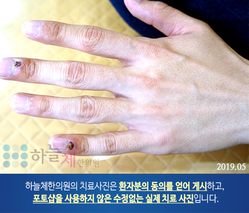 편평사마귀 치료
