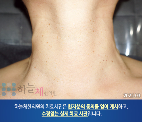 ] 편평사마귀 치료