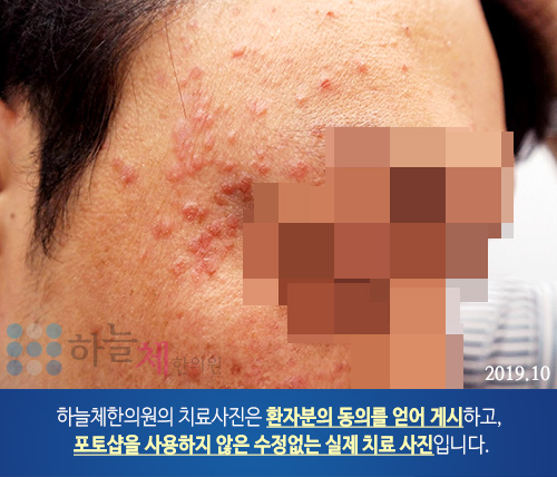 편평사마귀 치료