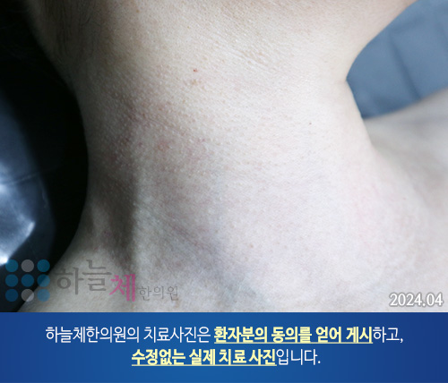 편평사마귀 치료