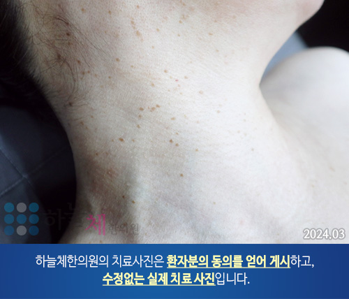 편평사마귀 치료
