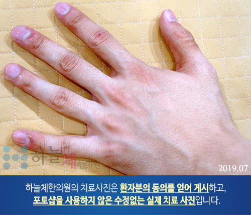 편평사마귀 치료