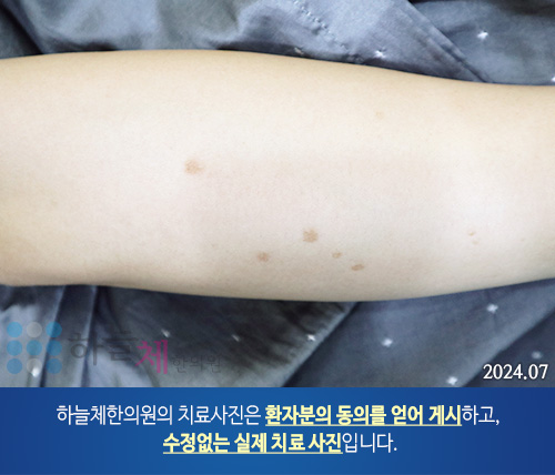 활동성 편평사마귀