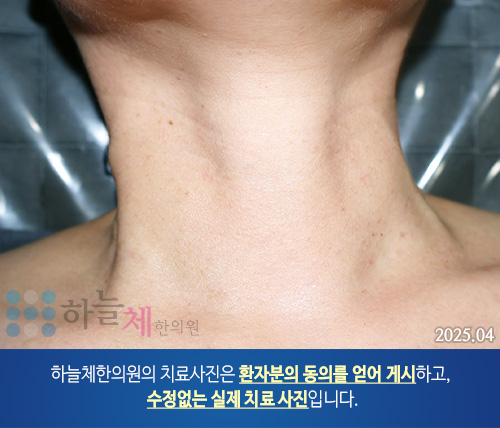 ] 편평사마귀 치료