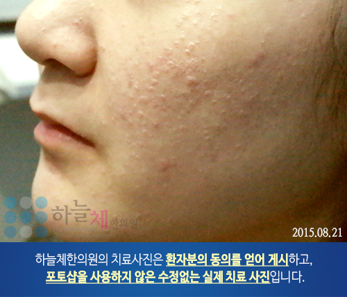 편평 사마귀 치료