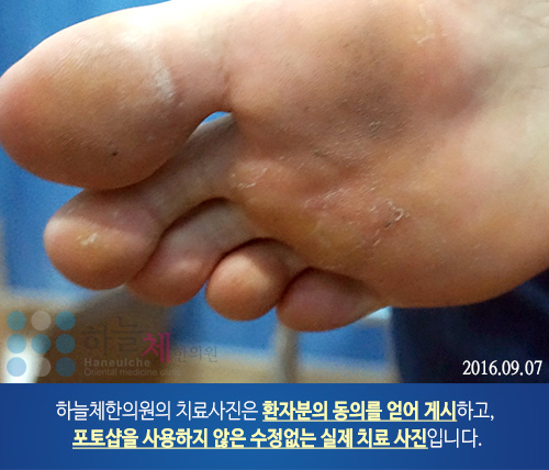 발 사마귀 치료
