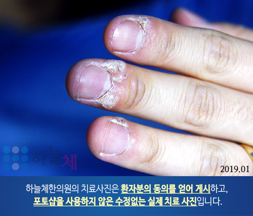  모낭염을 동반한 지루피부염 홍조