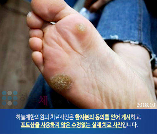 모낭염 치료