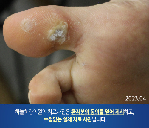 습진양 판상 병변 피부질환