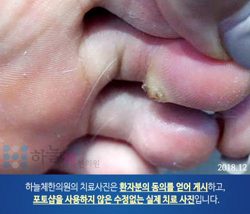 습진양 판상 병변 피부질환