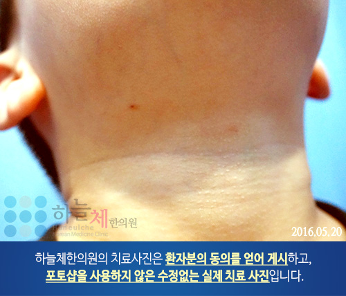 모낭염 치료