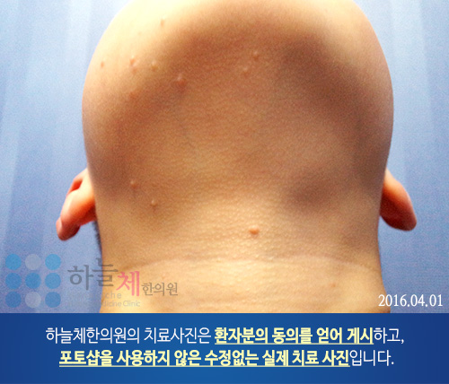 모낭염 치료