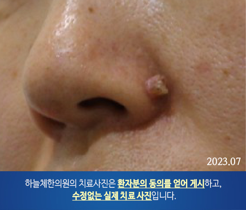 두드러기 치료