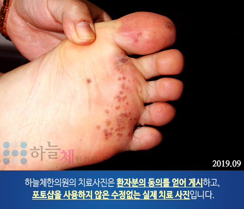 편평 사마귀 치료