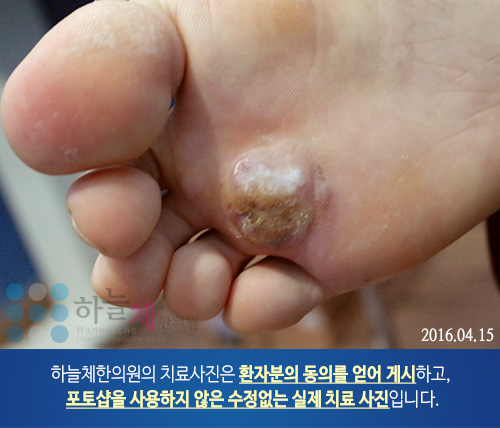 발 사마귀 치료
