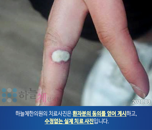 발 사마귀 치료