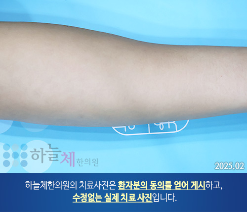 발 사마귀 치료