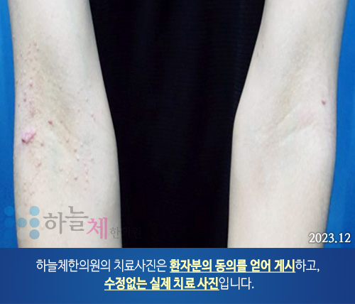  모낭염을 동반한 지루피부염 홍조