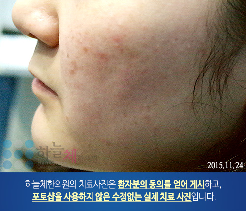 편평 사마귀 치료