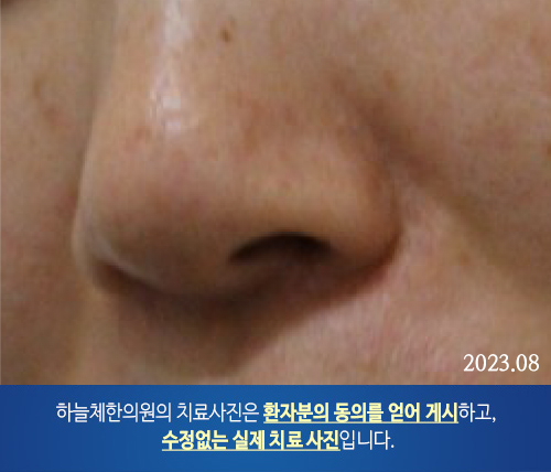 두드러기 치료