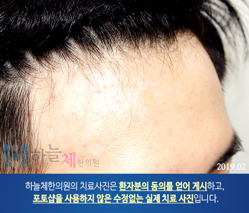 두드러기 치료