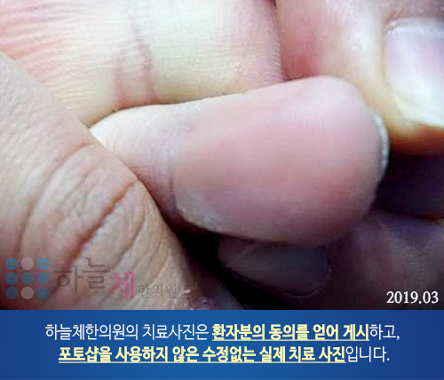 습진양 판상 병변 피부질환
