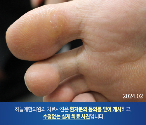 습진양 판상 병변 피부질환