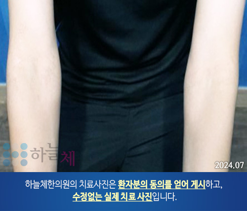  모낭염을 동반한 지루피부염 홍조