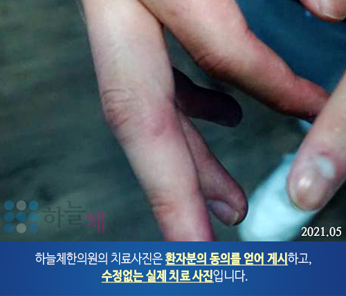 발 사마귀 치료