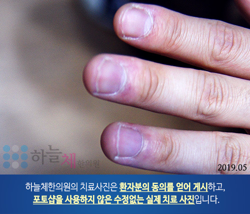  모낭염을 동반한 지루피부염 홍조
